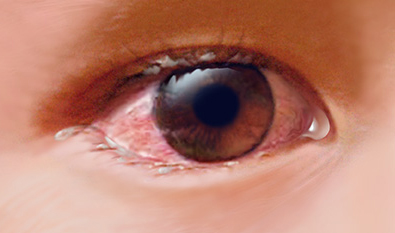 بیماری التهاب ملتحمه چشم در کودکان