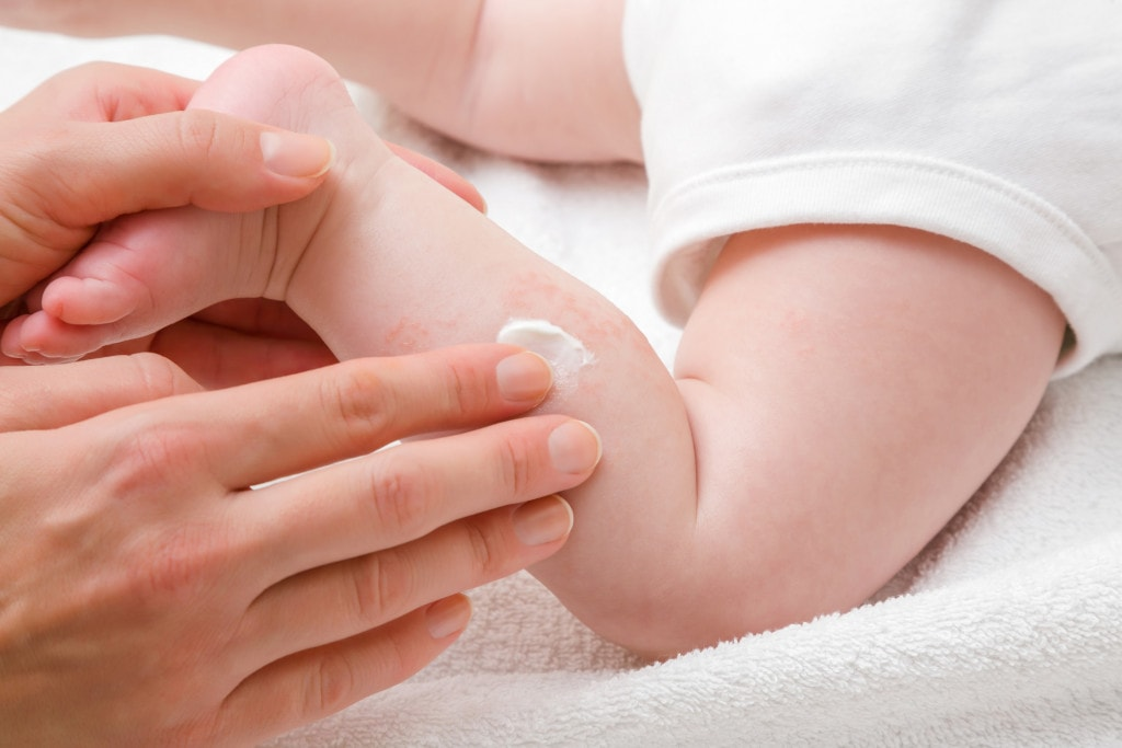 خشکی پوست بر اثر کمبود ویتامین آ (A) در کودکان

